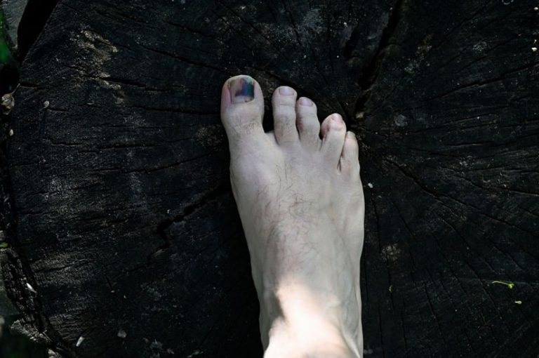 how-to-treat-and-prevent-black-toenail-while-running-causes-treatment