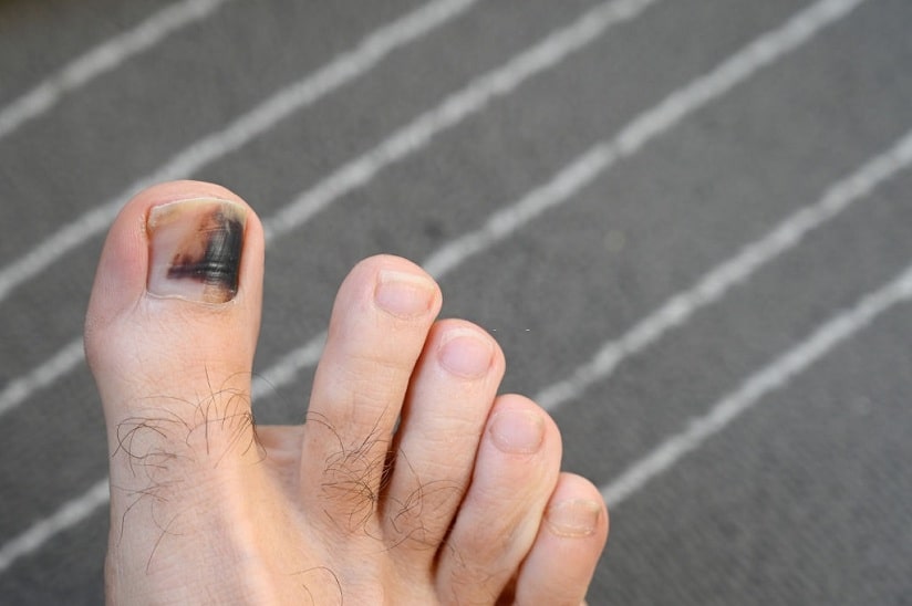 black toenails