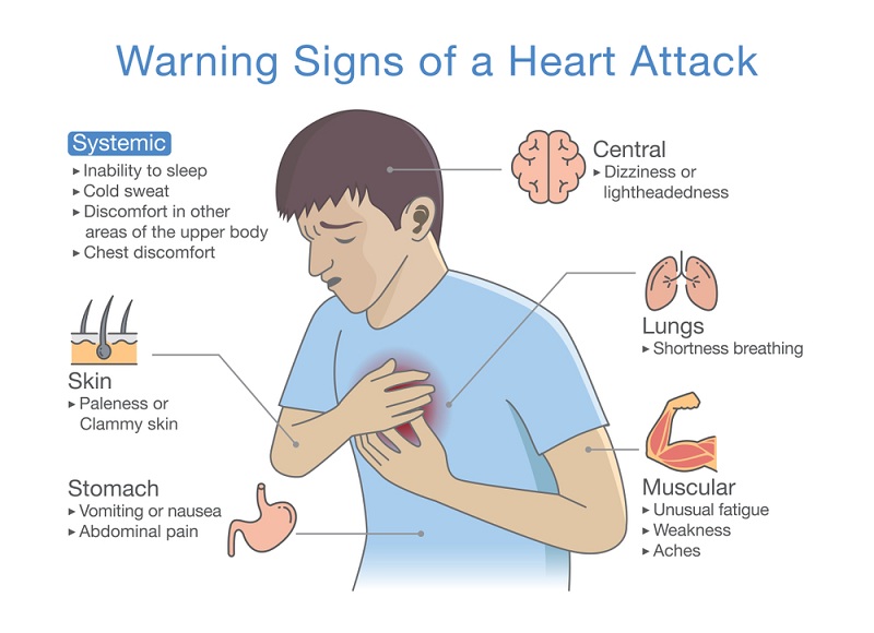 Can You Have A Heart Attack With A Normal Ekg - PELAJARAN