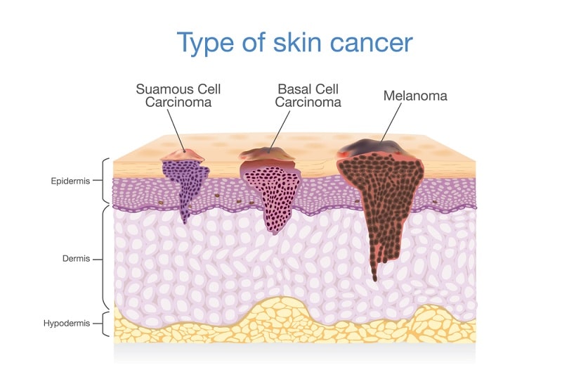 most serious type of skin cancer - illustration